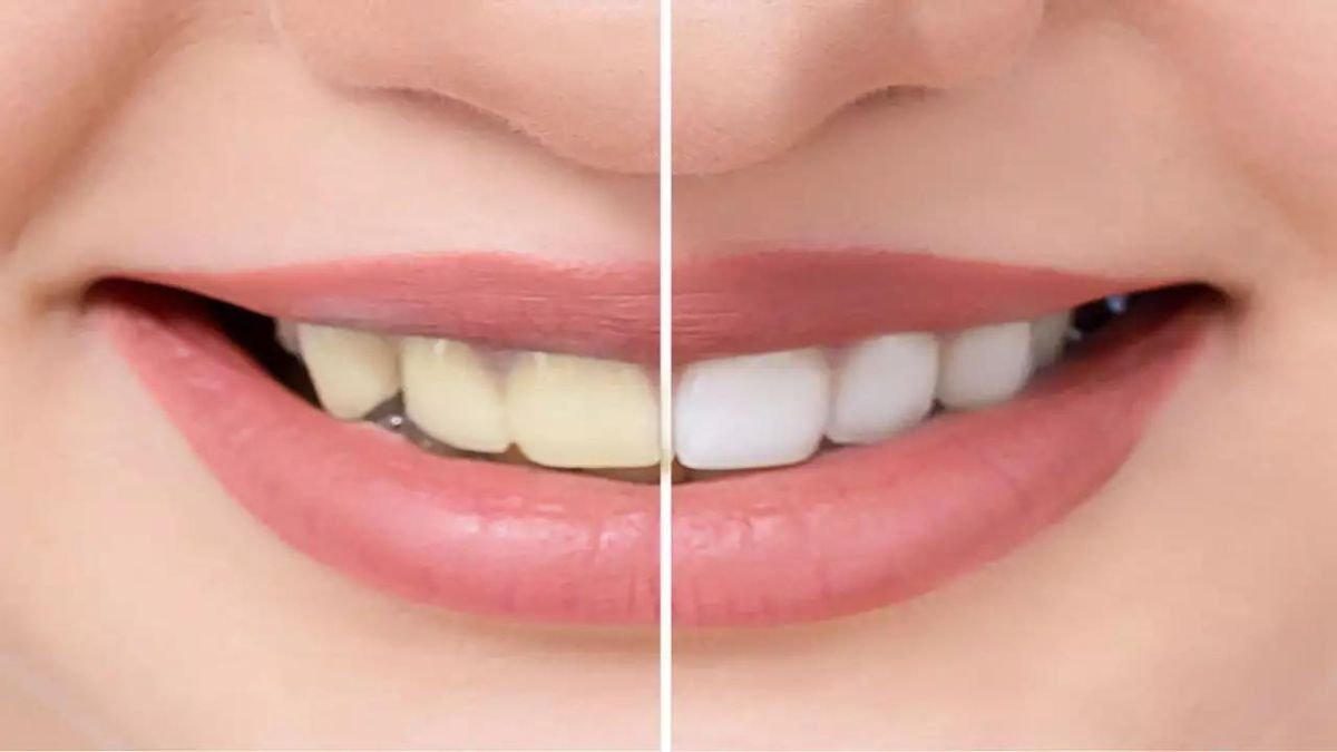 5 natural ways to get rid of yellow teeth