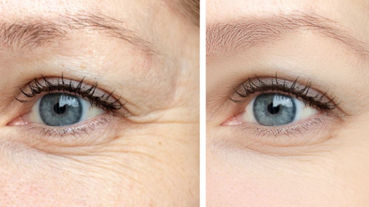 Yoga asanas to tighten skin around eye and reduce wrinkles