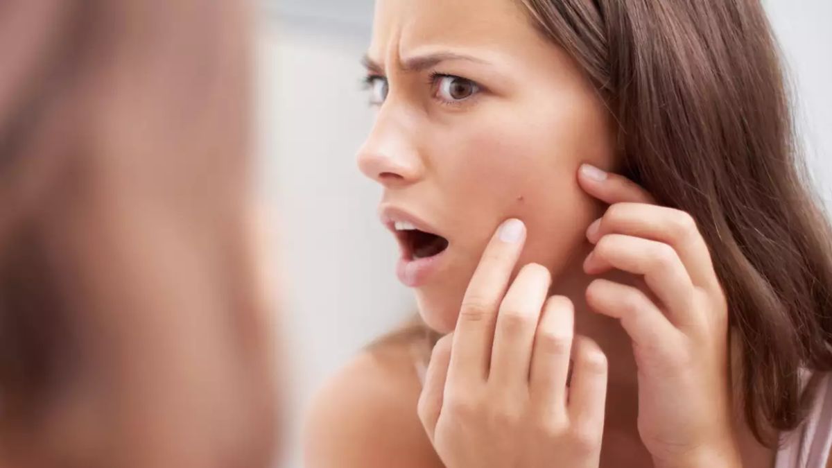 Want to get rid of pimples? Try these homemade face packs now