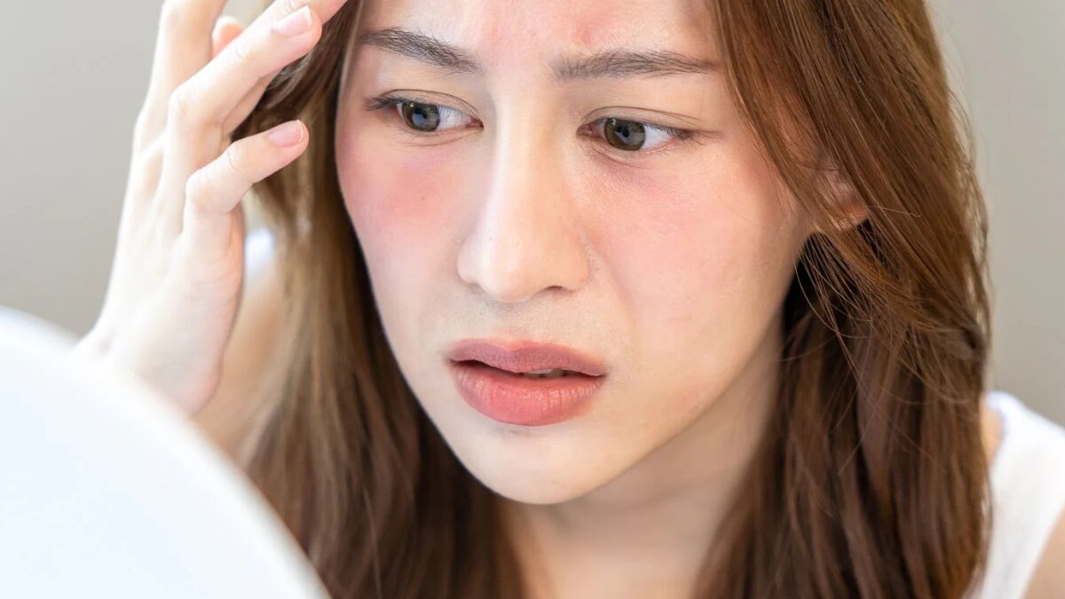 Organic ayurvedic solutions to heal sunburn during summers